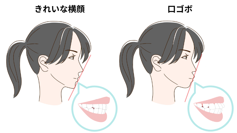 きれいな横顔と口ゴボ- 熊本市矯正歯科相談室