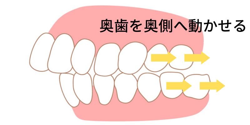奥歯を奥側へ動かす- 熊本市矯正歯科相談室