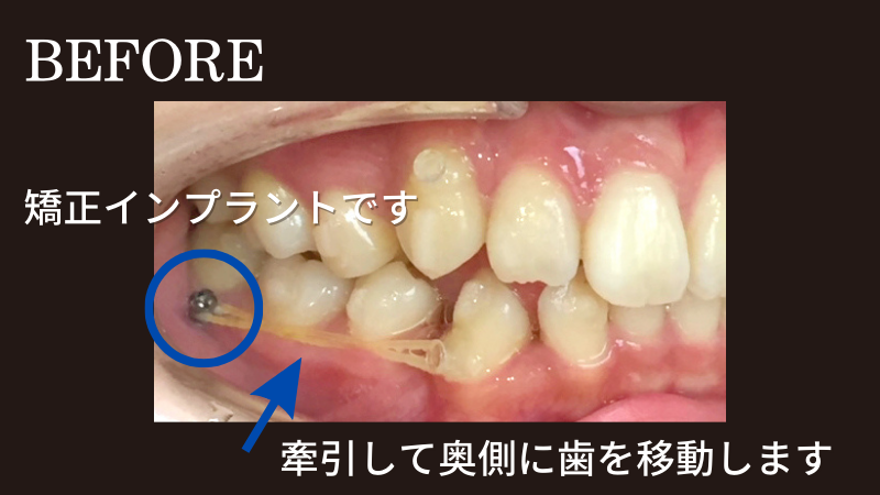 矯正インプラントで治療（治療中）- 熊本市矯正歯科相談室