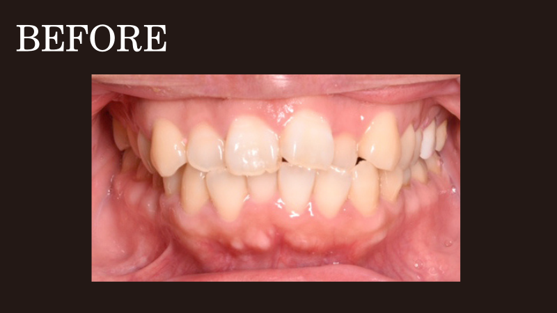 非抜歯で出っ歯とガタガタを治療- 熊本市矯正歯科相治療