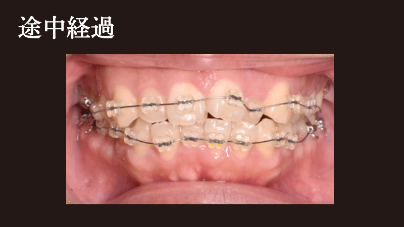非抜歯で矯正（治療中）- 熊本市矯正歯科相談室