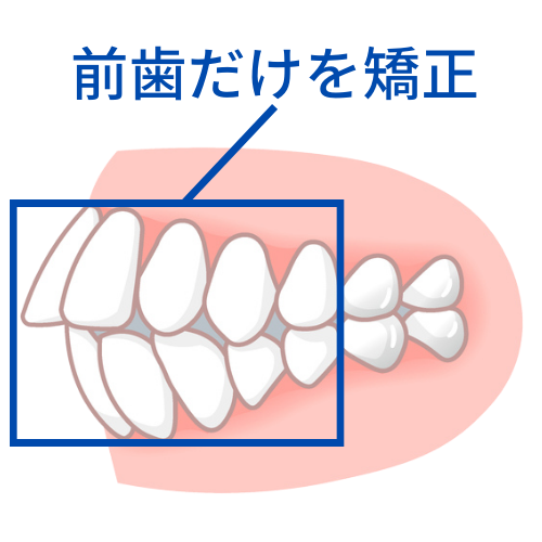前歯だけを矯正- 熊本市矯正歯科相談室
