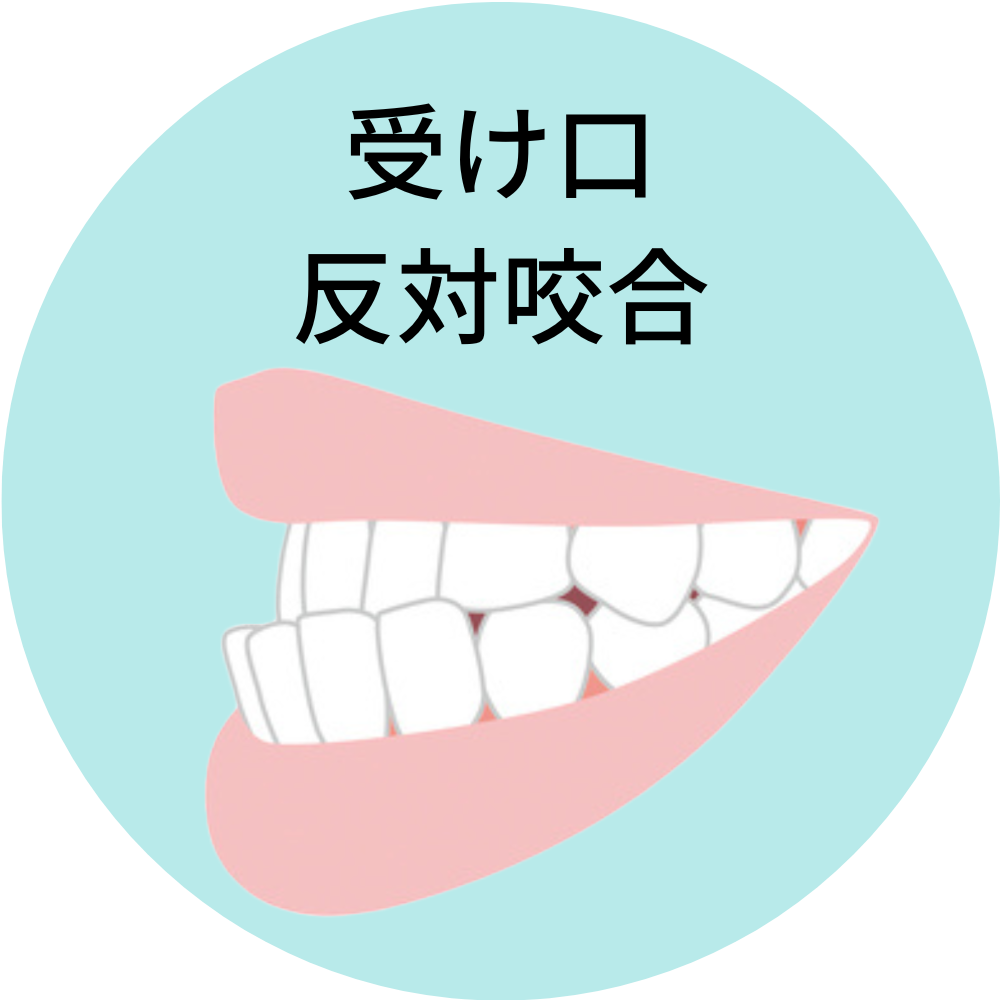 受け口- 熊本市矯正歯科相談室