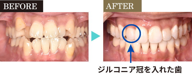 八重歯の治療- 熊本市矯正歯科相談室