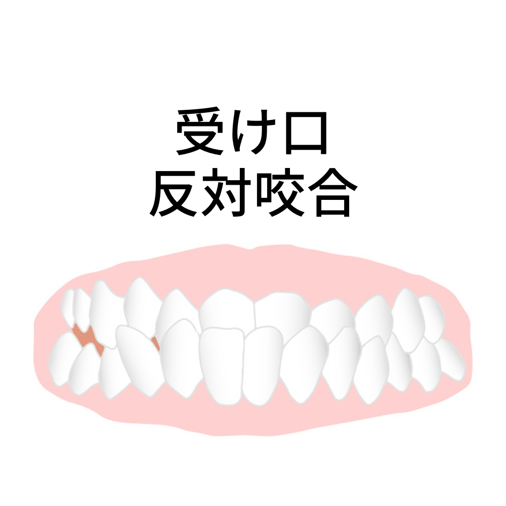 受け口・反対咬合- 熊本市矯正歯科相談室