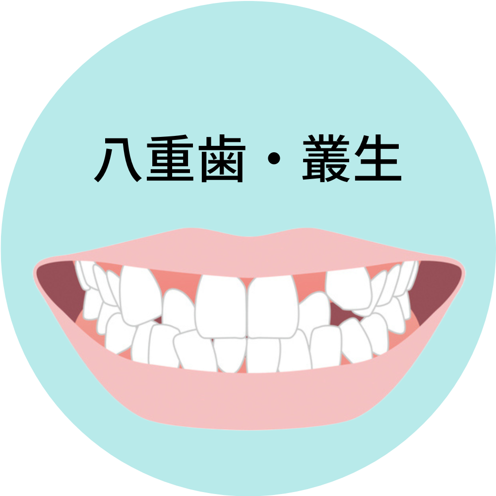 八重歯・叢生- 熊本市矯正歯科相談室