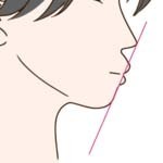 矯正治療の失敗